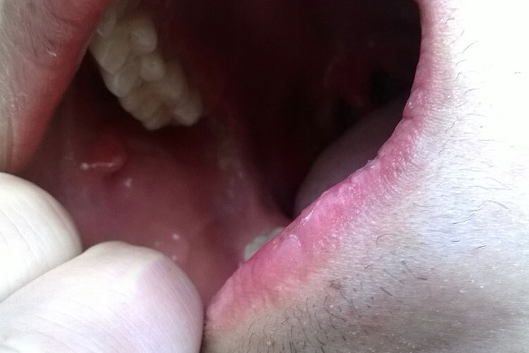 口唇黏膜皮损图