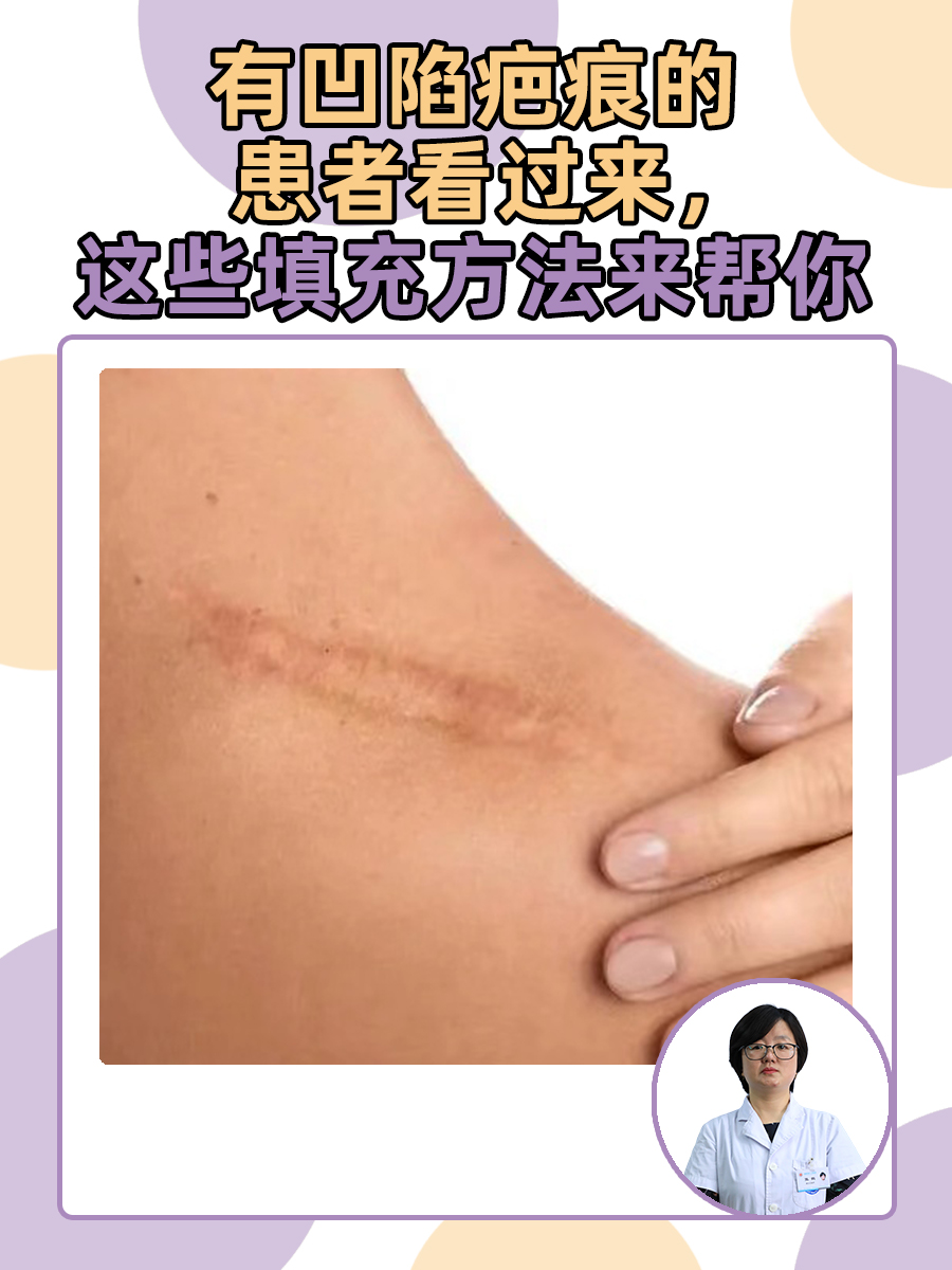 有凹陷疤痕的患者看过来，这些填充方法来帮你