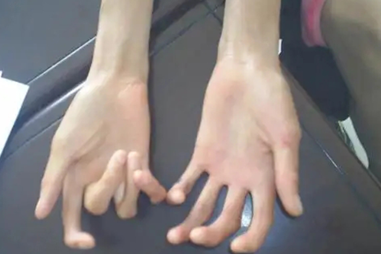 马方综合征蜘蛛指图 马方综合征蜘蛛指图