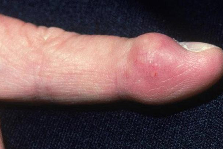 骨肿瘤手指肿胀图 骨肿瘤手指肿胀图