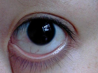 干燥综合征眼睛很干眼球还有红血丝图.jpg