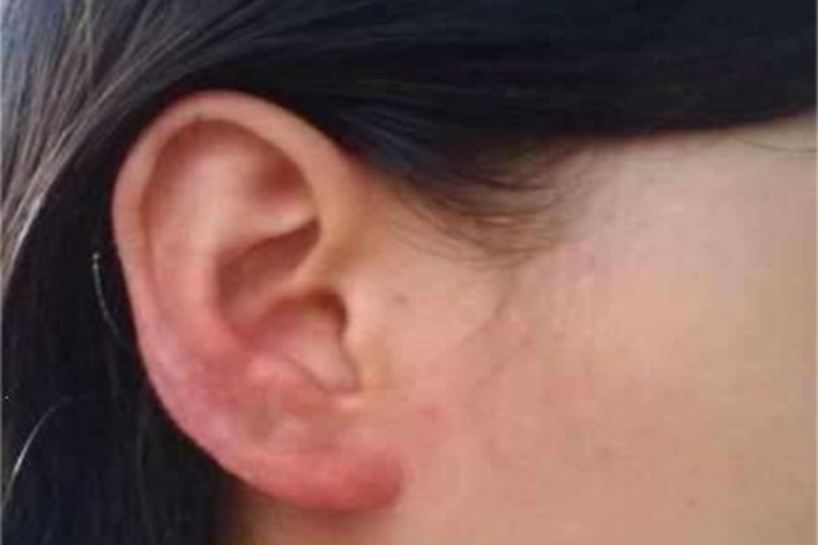 体虱病耳部红肿图