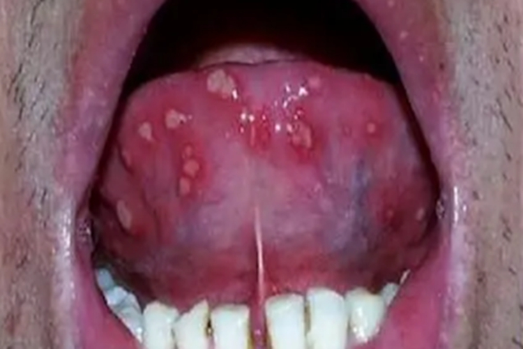 口腔单纯性疱疹舌头图