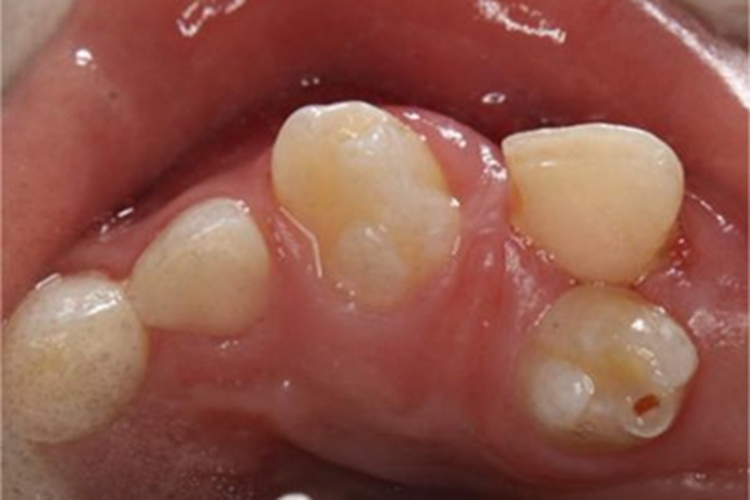多生牙牙齿症状图