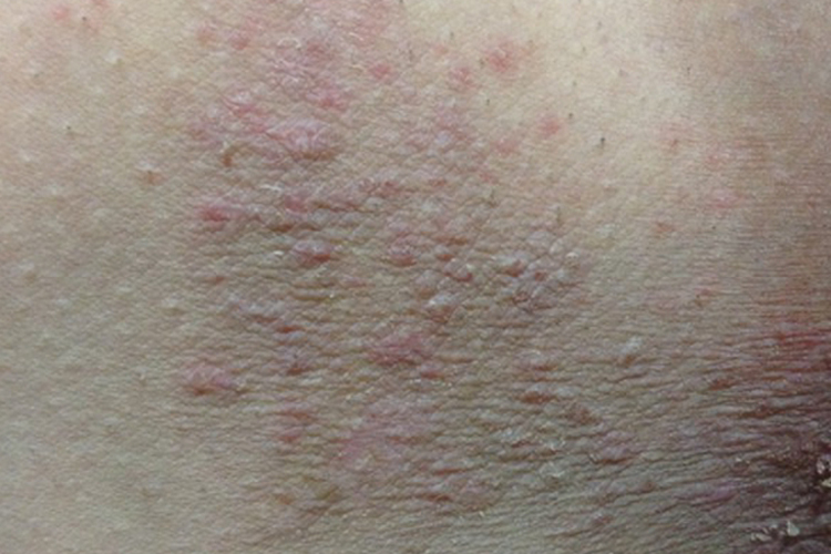 大腿窝两侧毛周角化症图