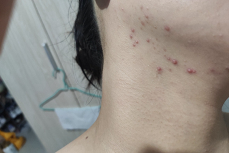毛囊炎颈部小疙瘩脓疱图