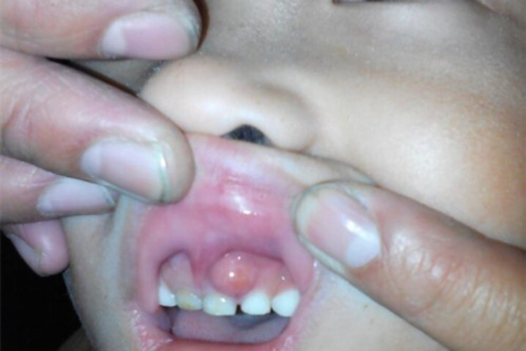 急性化脓性根尖周炎脓包图