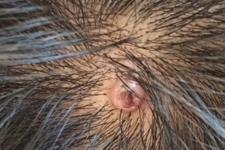 头上皮脂腺囊肿图