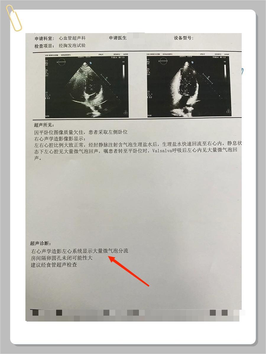 卵圆孔未闭，该如何应对？这篇告诉你