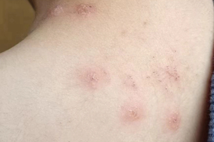 虫咬皮炎背部小疙瘩图