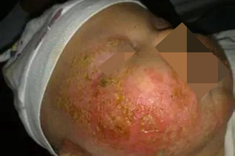 急性湿疹面部红斑黄痂图