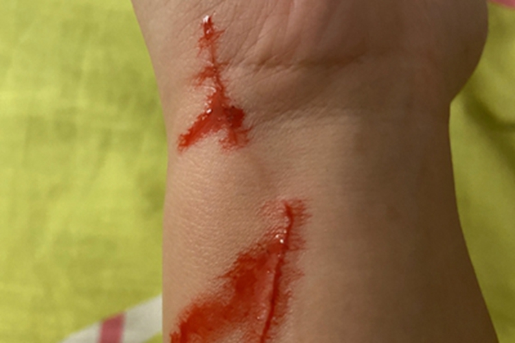 抓伤前臂血丝伴出血图