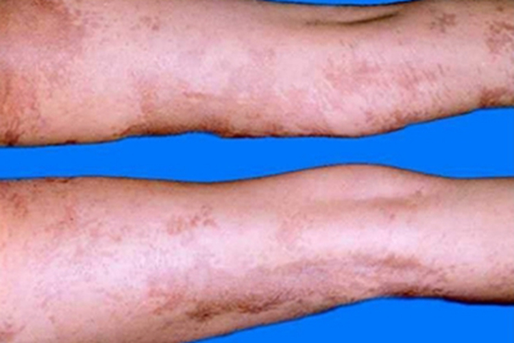 进行性特发性皮肤萎缩腿斑图