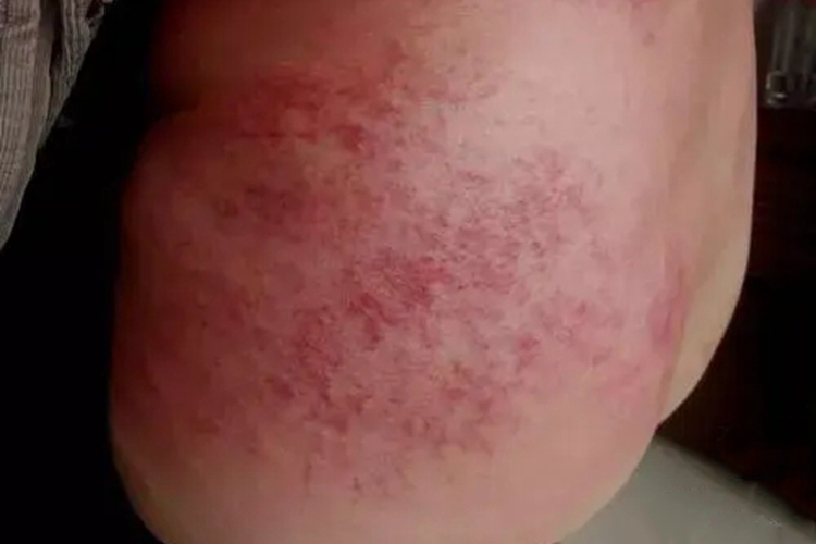 胯部急性接触性皮炎图 胯部急性接触性皮炎图