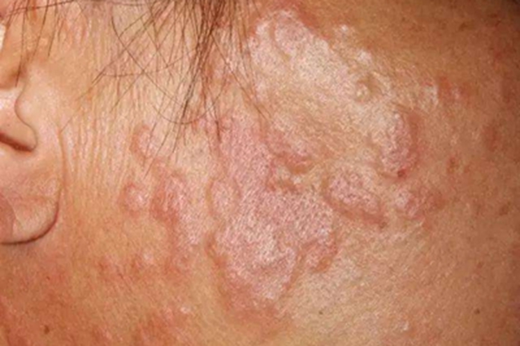 丘疹型环状肉芽肿面部症状图