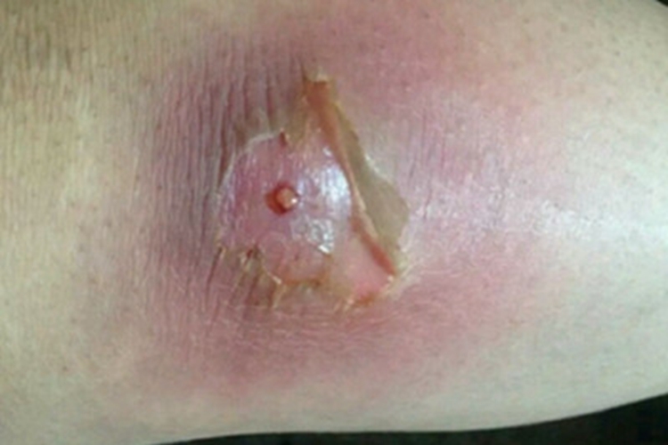痈大腿红肿图