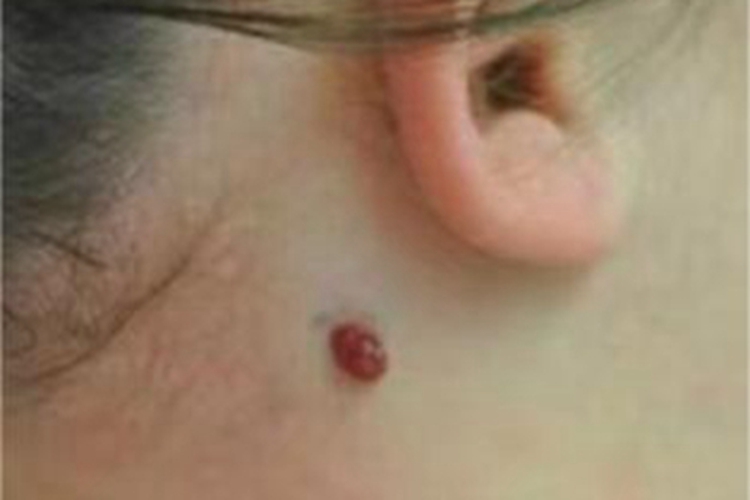 肉芽肿型血管瘤耳后症状图