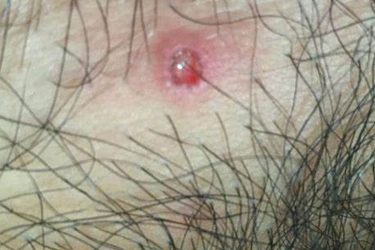 女性生殖器梅毒硬下疳图