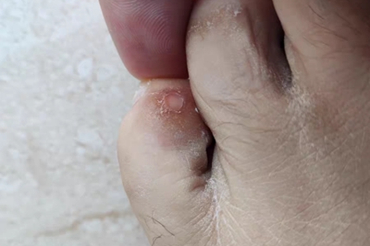 鸡眼脚趾缝症状图 鸡眼脚趾缝症状图