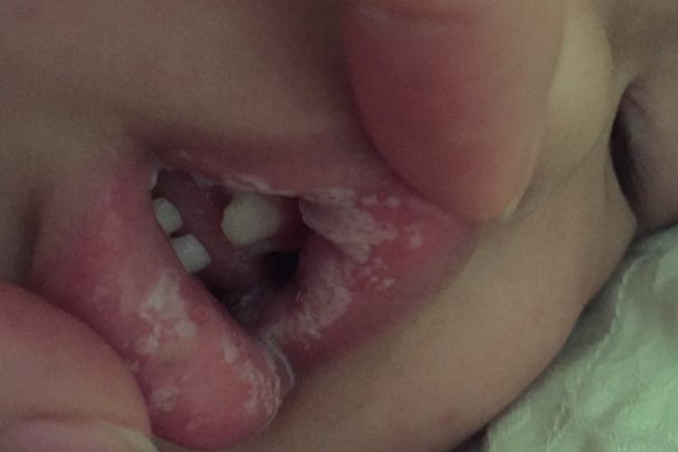 口腔白色大片状膜图