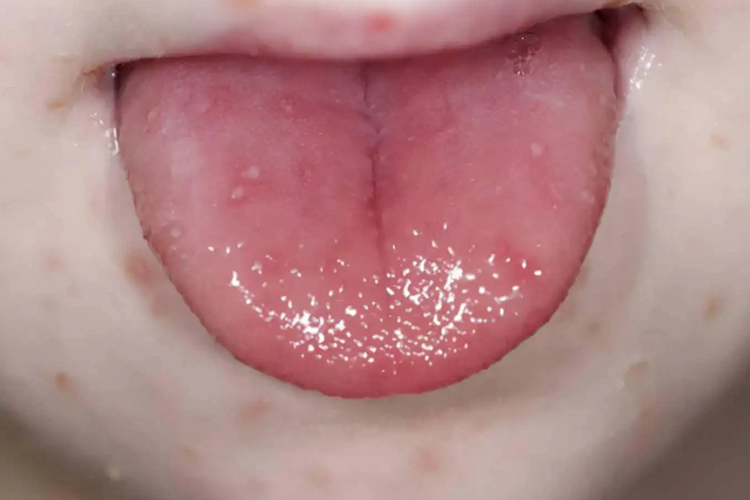 小孩舌头疱疹性口炎图