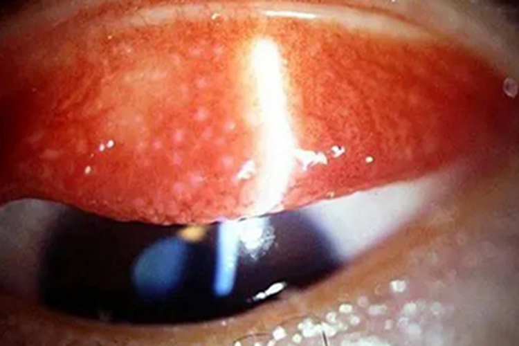 结膜炎小水疱图