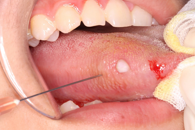 舌侧乳头状瘤图