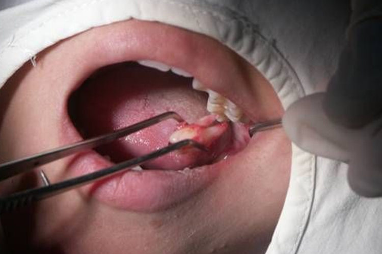 拔除智齿图 拔除智齿图