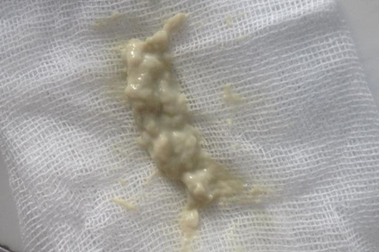 凝乳状白带图 凝乳状白带图