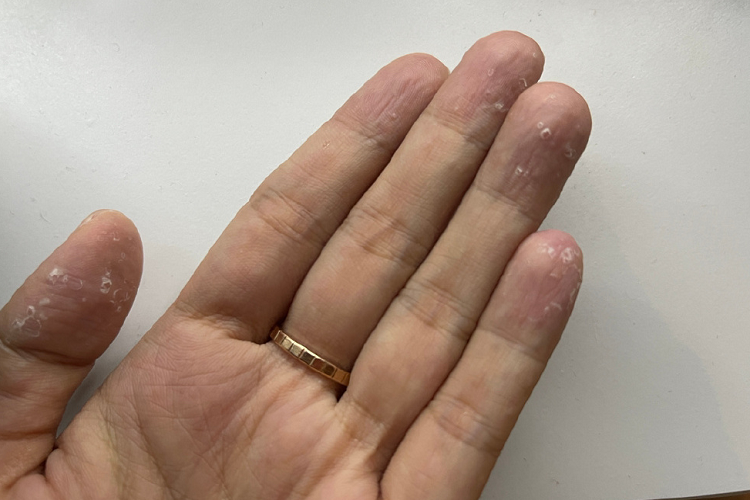 汗疱疹手指脱屑图 汗疱疹手指脱屑图