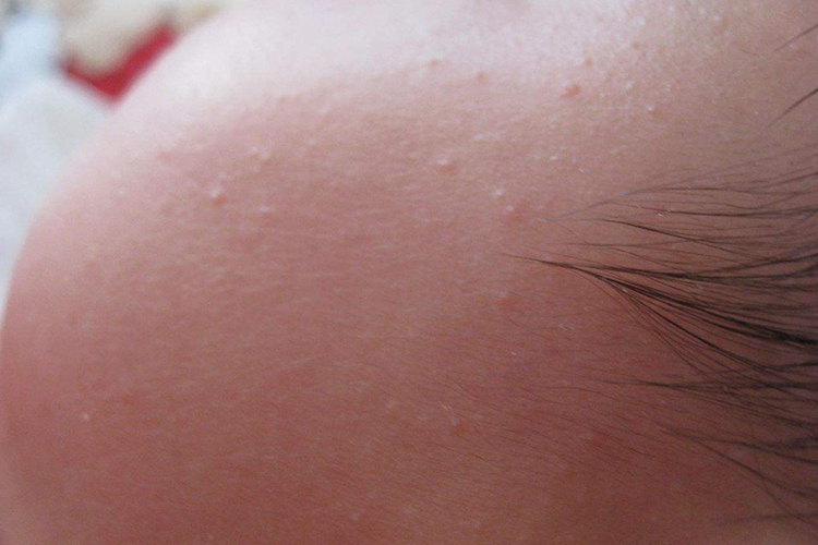 婴儿脸上栗丘疹图 婴儿脸上栗丘疹图