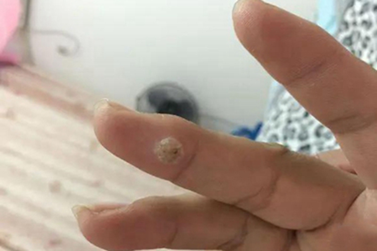 疣手指肉球图