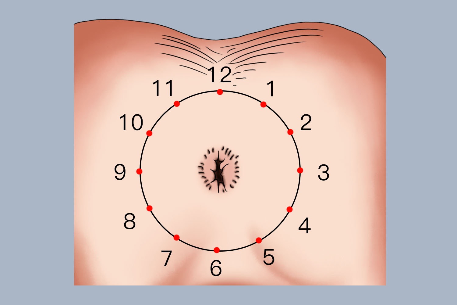 膝胸位痔疮时钟定位法