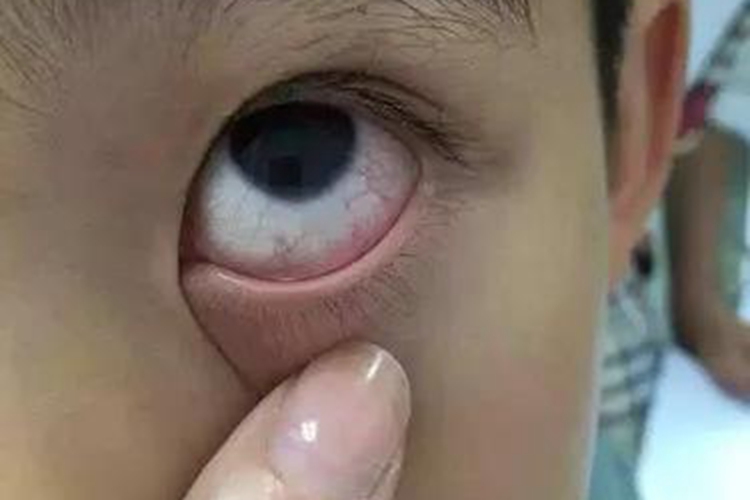 儿童轻型麻疹图 儿童轻型麻疹图