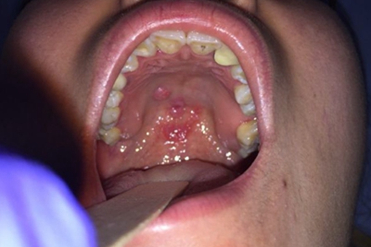 二期口腔梅毒上牙膛充血图