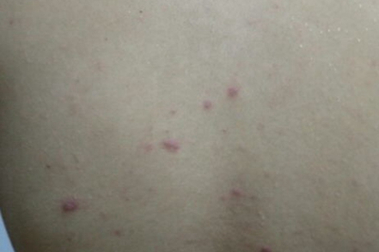 毛囊炎背部有红色丘疹图