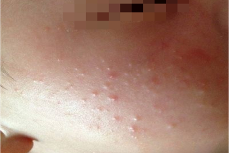 急性湿疹脸上长很多小疱图