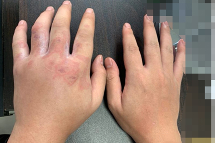 刺胞皮炎手背红斑图 刺胞皮炎手背红斑图
