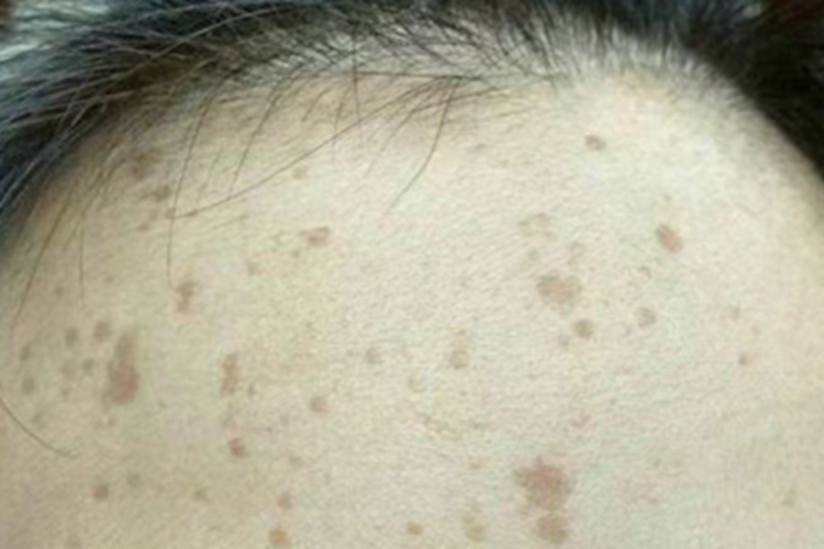 扁平疣额头好多褐色斑图