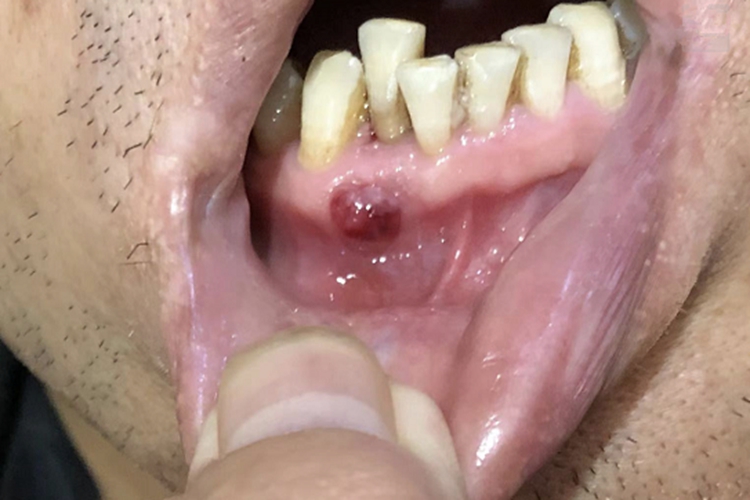 急性化脓性根尖周炎口腔症状图