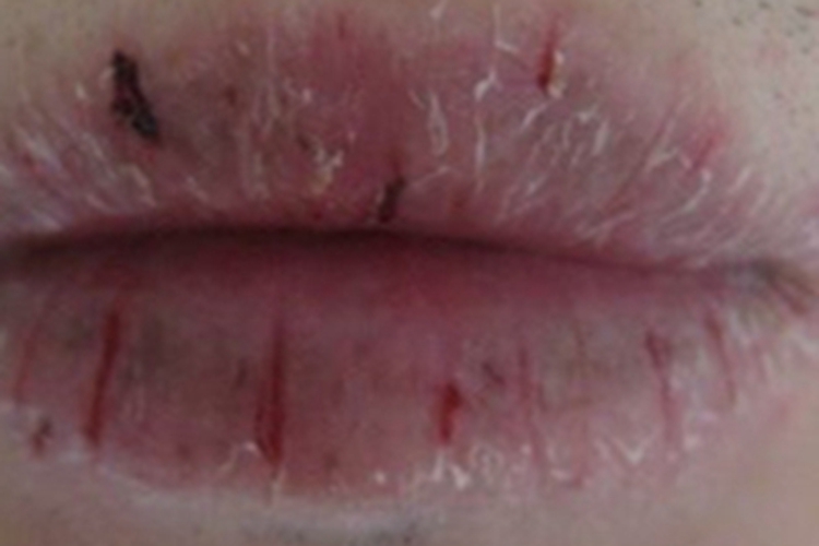 慢性光化性唇炎嘴唇出血图
