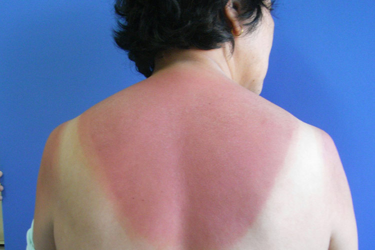 日晒伤弥漫性红斑症状图 日晒伤弥漫性红斑症状图