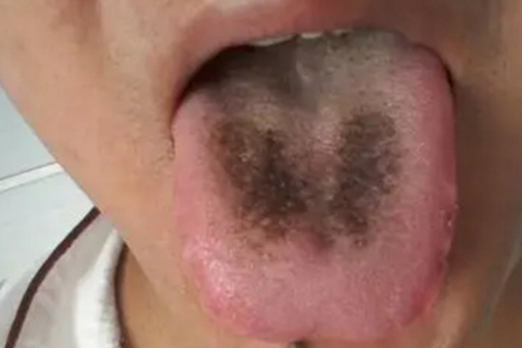 毛舌舌头一块黑色图 毛舌舌头一块黑色图