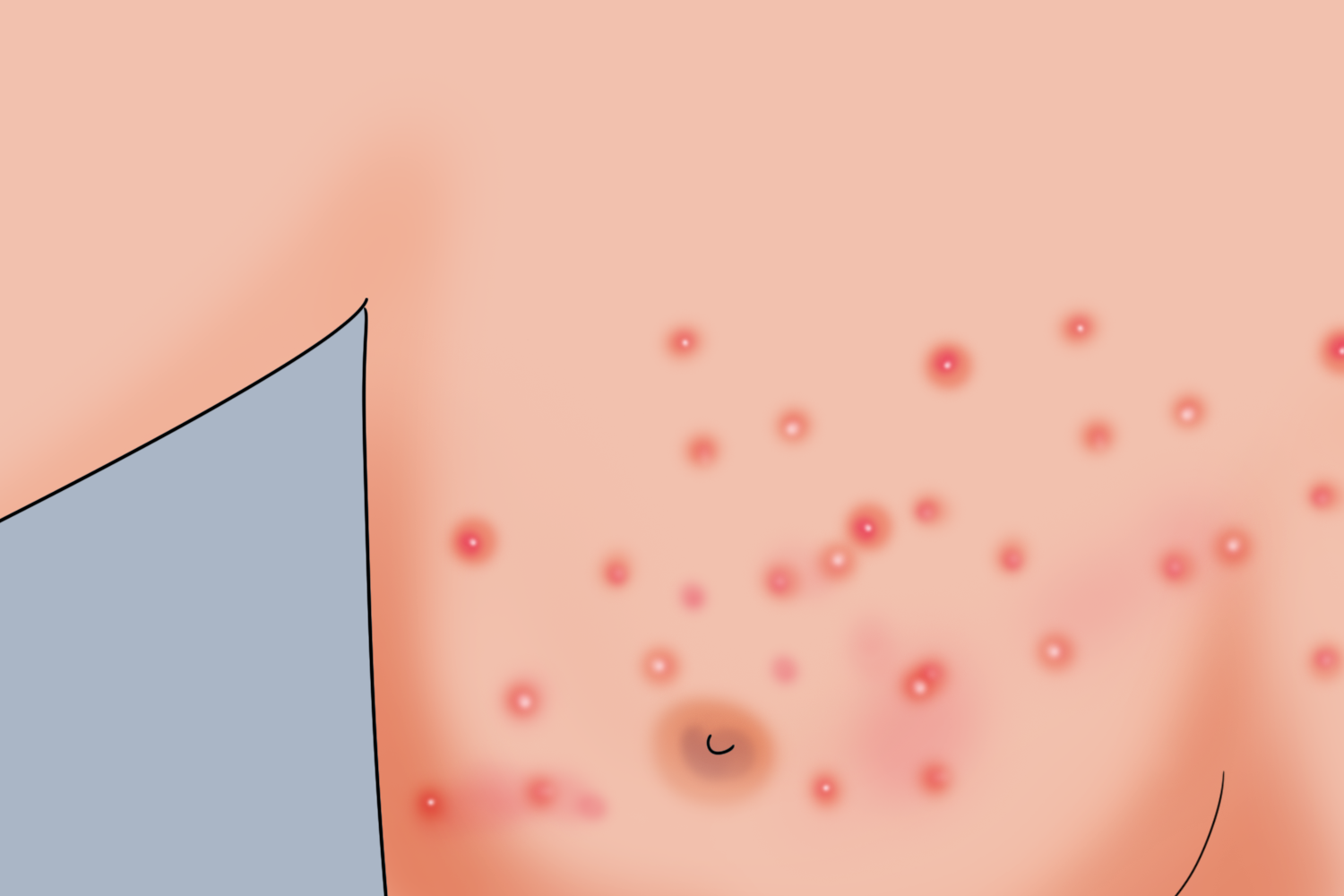 寻常痤疮乳房上有小疙瘩图