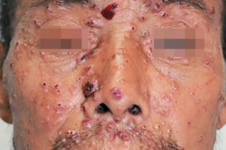 播散性马尔尼菲青霉病面部症状图