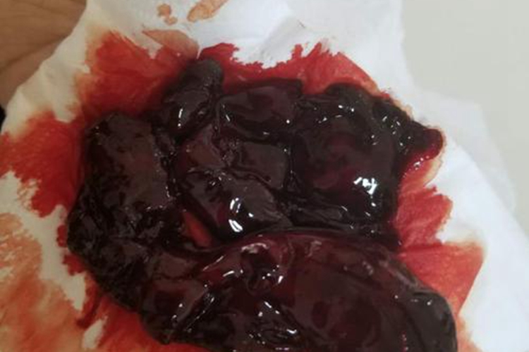 胎盘因素排出黑血块图