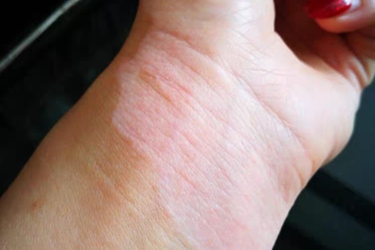 非节段型白癜风手腕长斑图