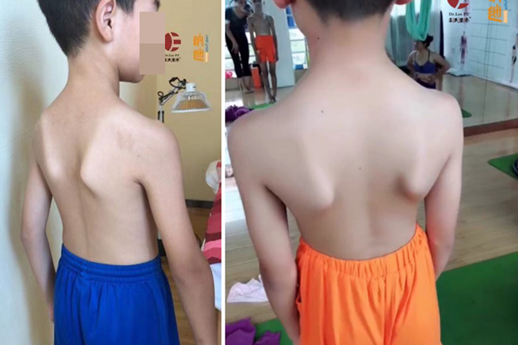 儿童翼状肩胛骨突出图