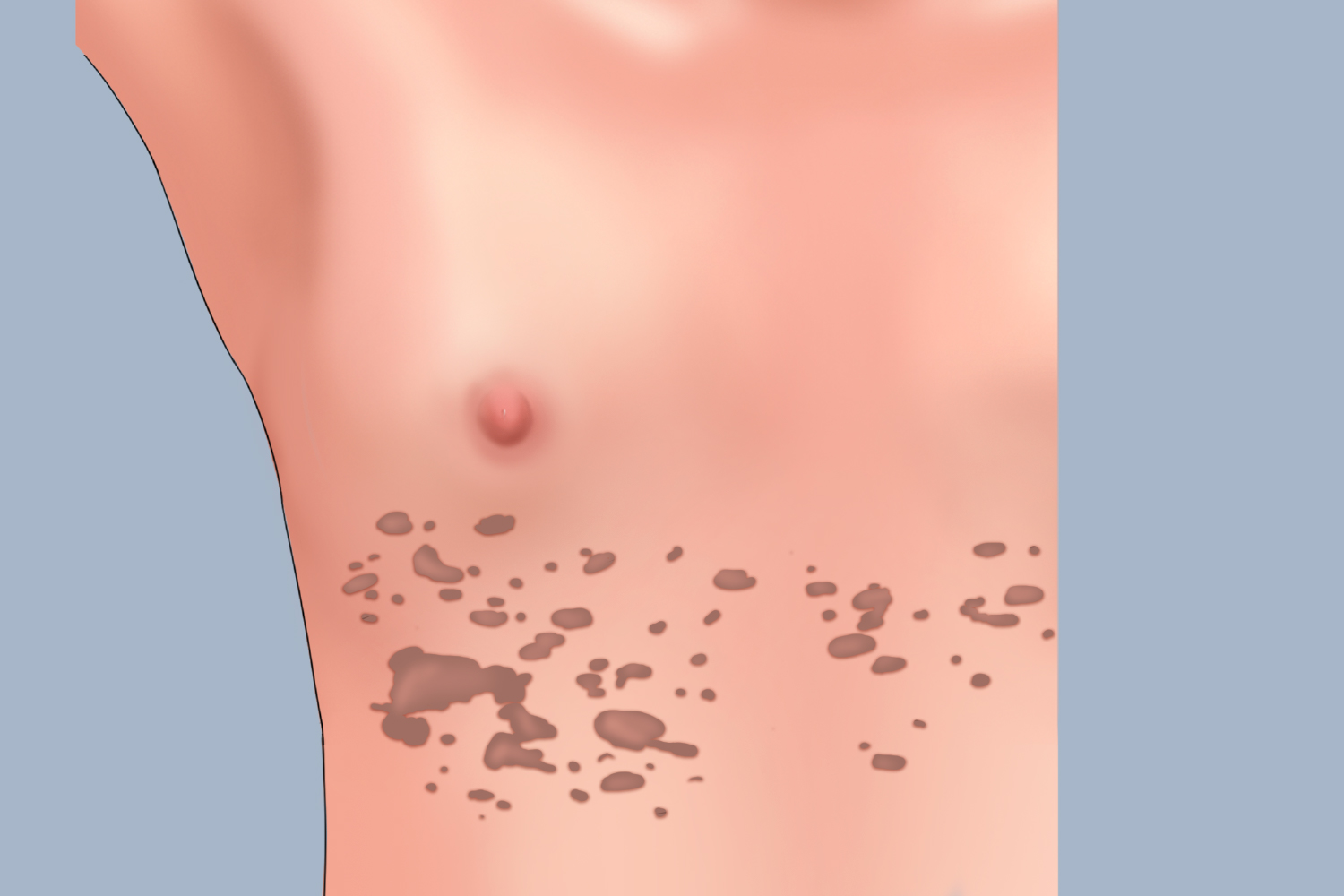 胸下面花斑癣图