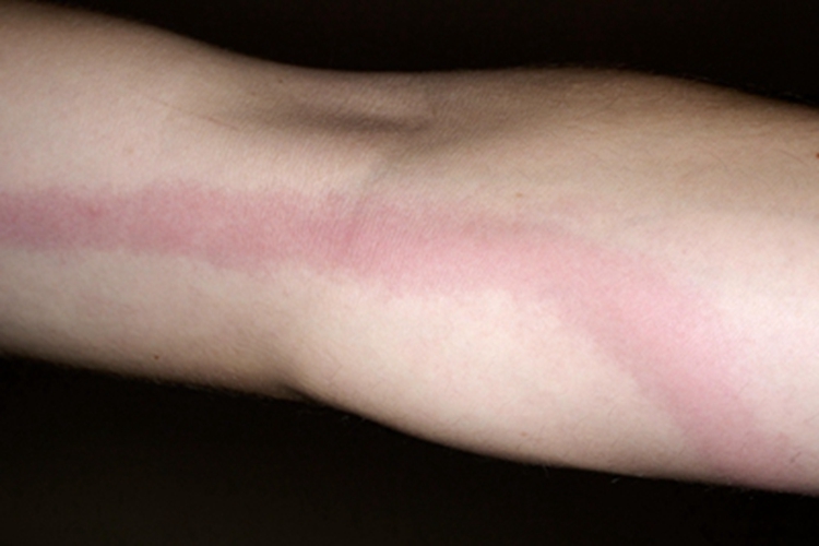 丝虫病急性期胳膊出现红斑图